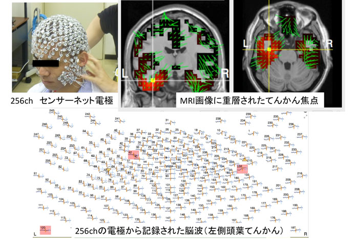 高密度脳波検査(256ch脳波)モニター写真