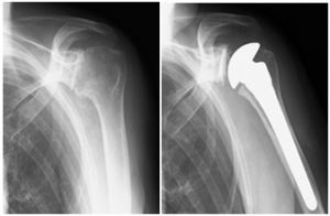 人工肩関節置換術のレントゲン写真