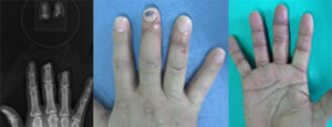 切断指再接着手術のレントゲン写真