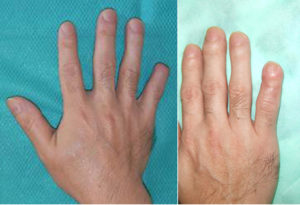 爪欠損の再建手術の説明画像