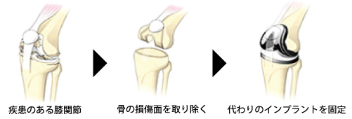 人工膝関節置換術の経過説明イラスト。損傷面を取り除きインプラントを挿入する