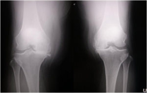 手術前の変形性膝関節症（両側同時人工膝関節置換術）レントゲン写真