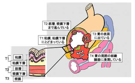 胃がん進行度の説明イラスト