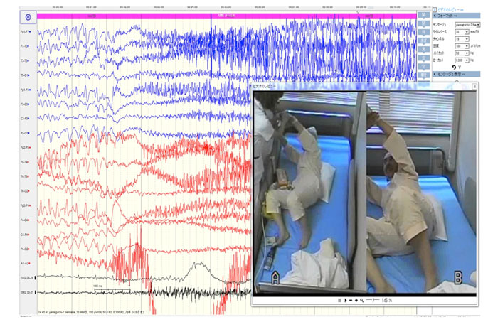 長期継続脳波ビデオ同時記録画像