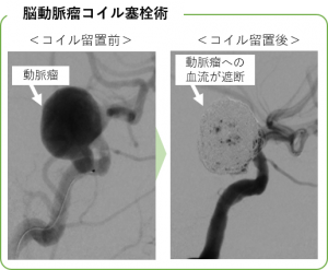 脳動脈瘤コイル塞栓術